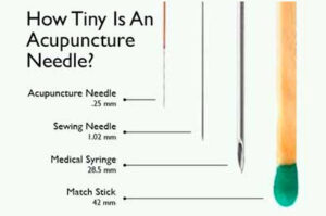 acupuncture-needle-hurt