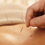 Acupuncture Northern Beaches