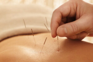 Acupuncture Northern Beaches