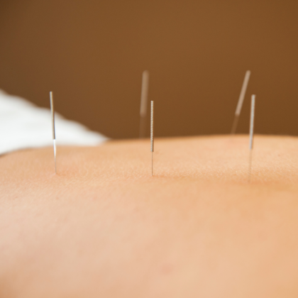 Acupuncture evidence