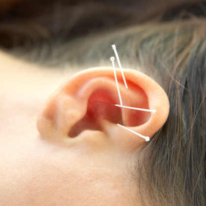 Ear Auricular SAAT Acupuncture Alpha Gal Syndrome Ear Auricular SAAT Acupuncture Alpha Gal Syndrome