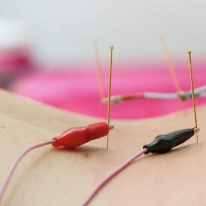 TENS Electroacupuncture