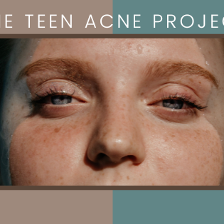 Teen Acne Project